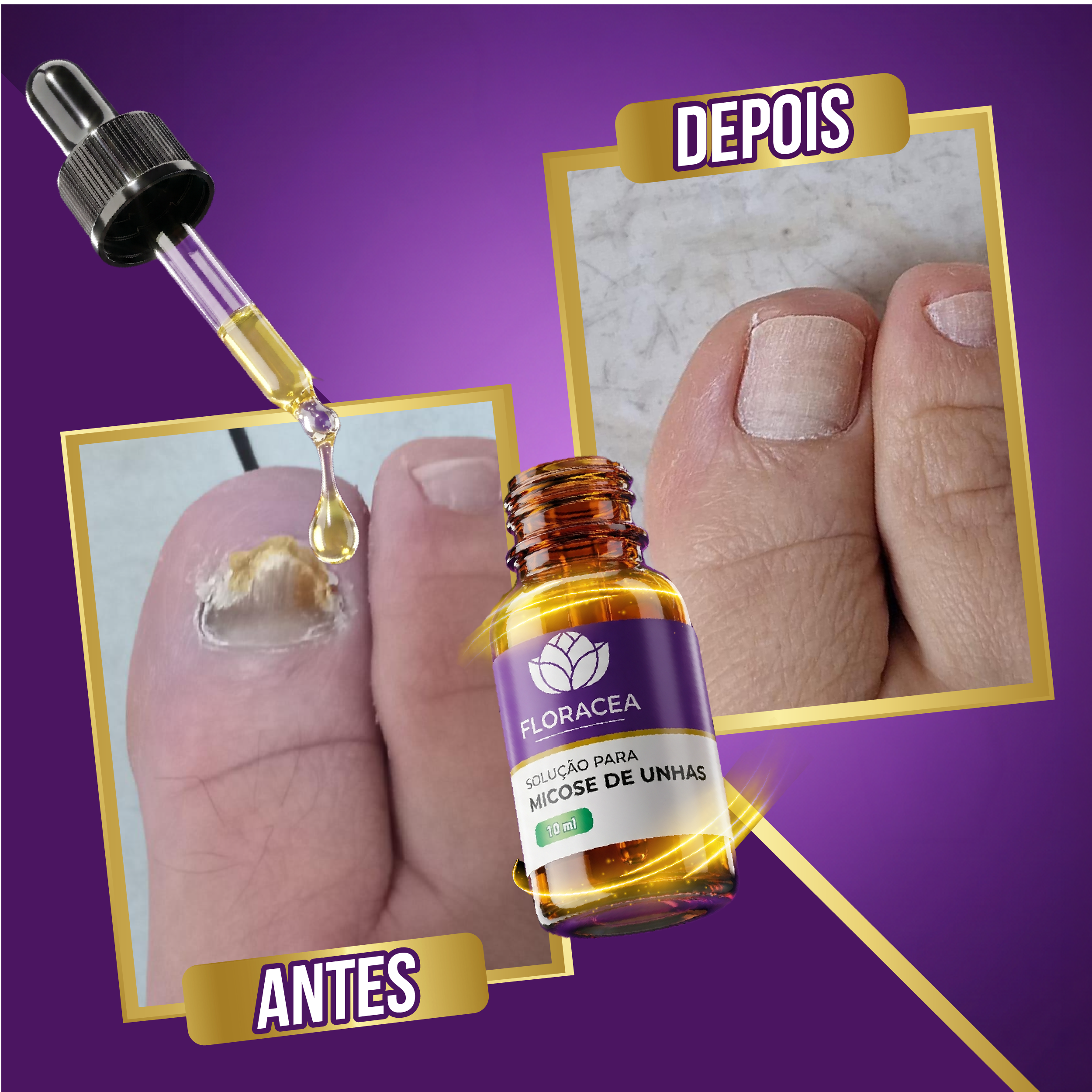 Solução de Micose 10ml
