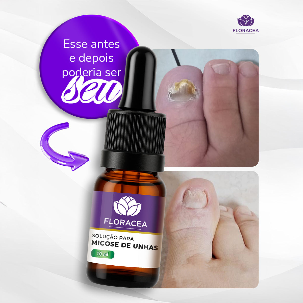 Combo 3 Solução de Micose 10ml + 1 Higienizante para Calçados 120ml - imagem 4