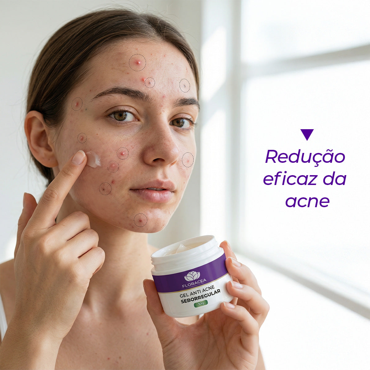 Gel Anti-acne Clareador e Seborregular 30g - imagem 2